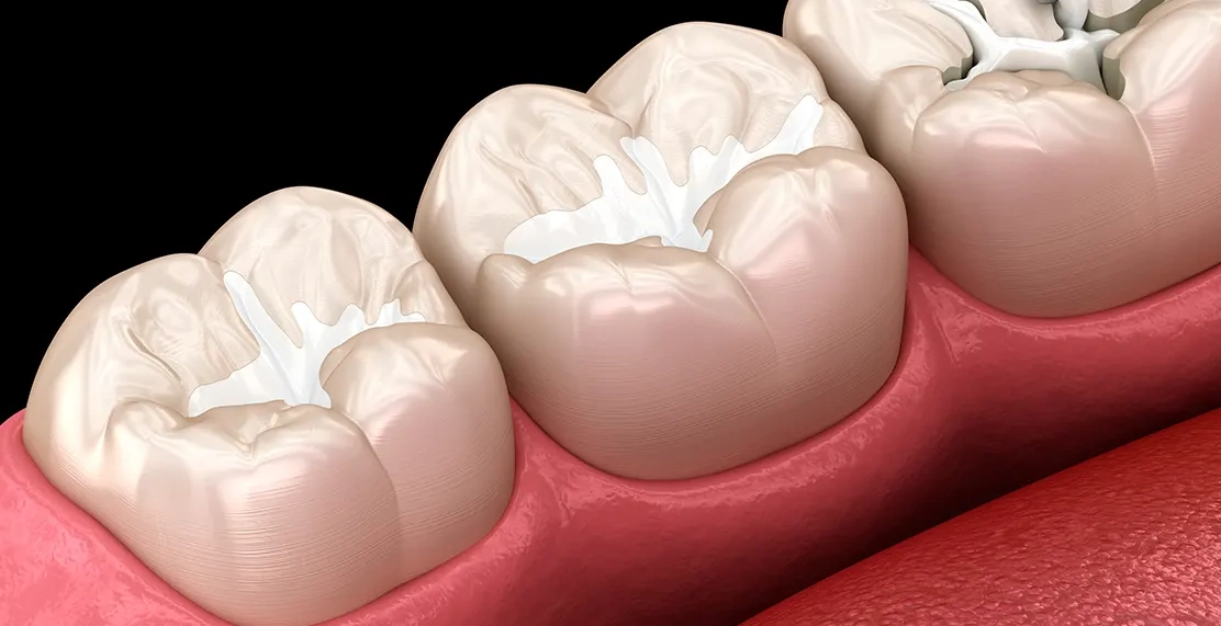 Dental_Sealants Dental_Sealants