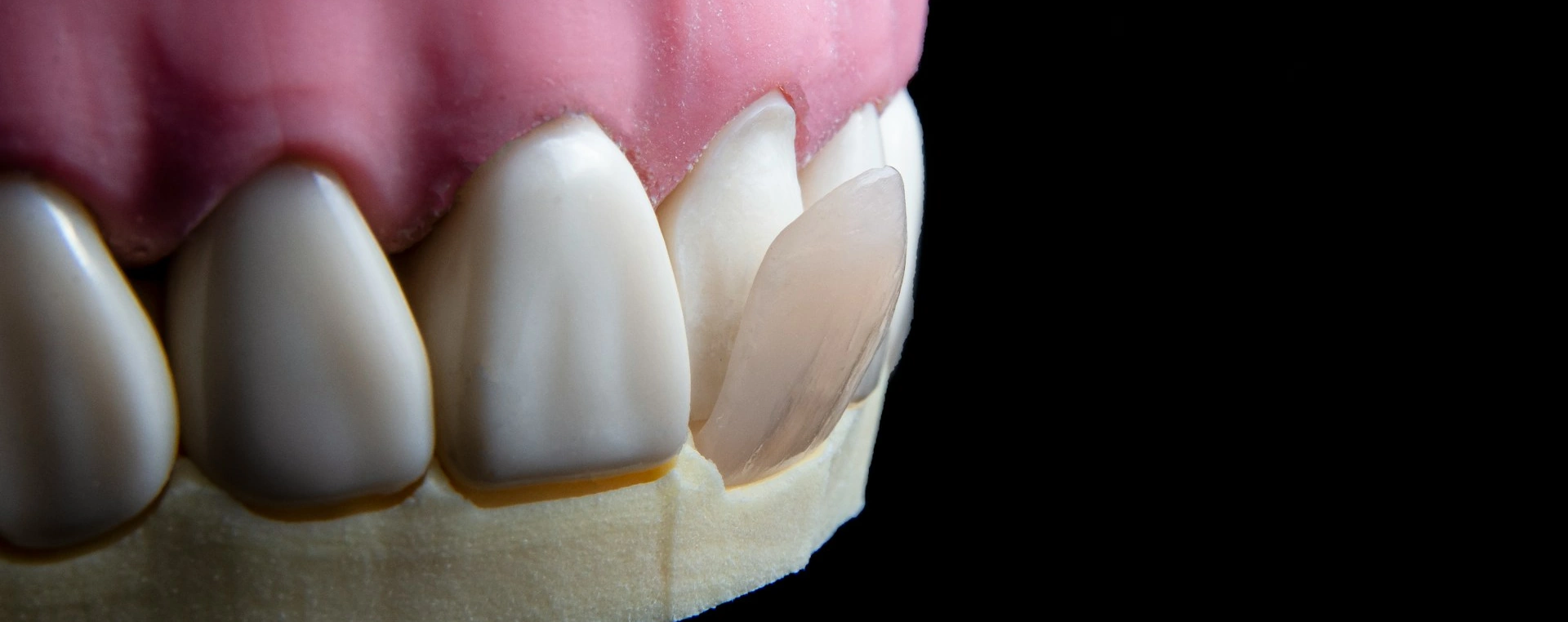 Resin_Veneers-PhotoBy-Ozkan_Guner-On_Unsplash-cropped Resin_Veneers-PhotoBy-Ozkan_Guner-On_Unsplash-cropped