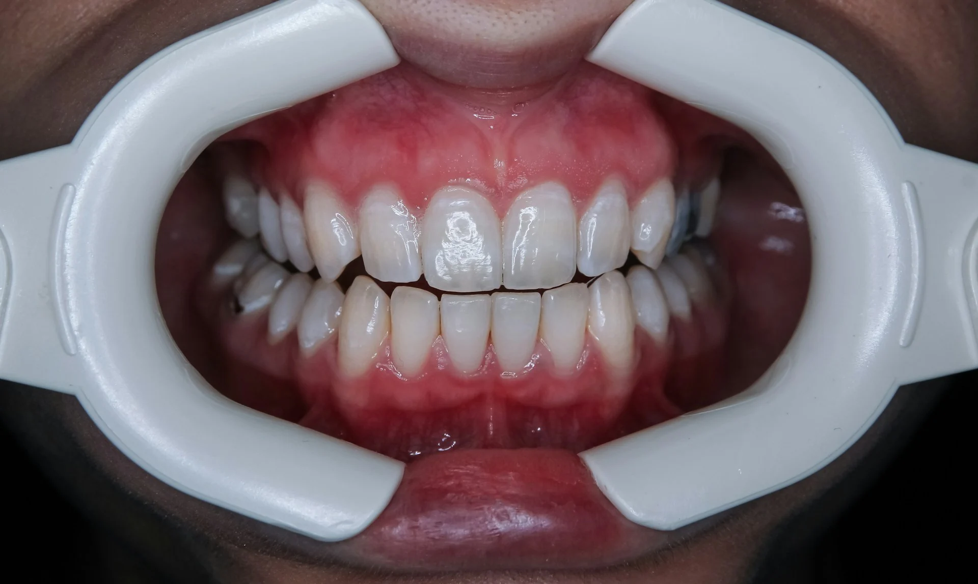 Teeth_Whitening-PhotoBy-Ozkan_Guner-On_Unsplash Teeth_Whitening-PhotoBy-Ozkan_Guner-On_Unsplash